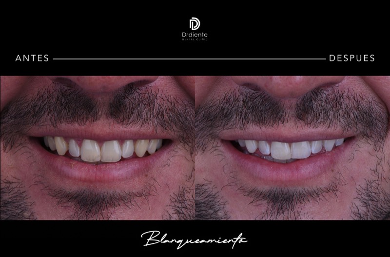 Resultado inmediato — sonrisa más luminosa y uniforme