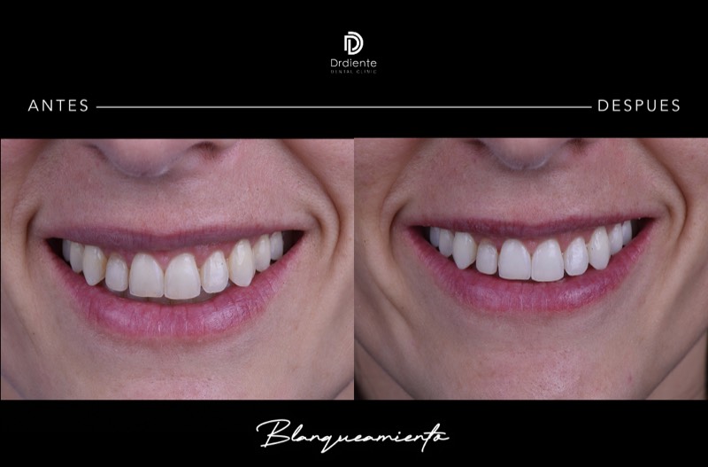 Blanqueamiento Dental — Caso real antes y después