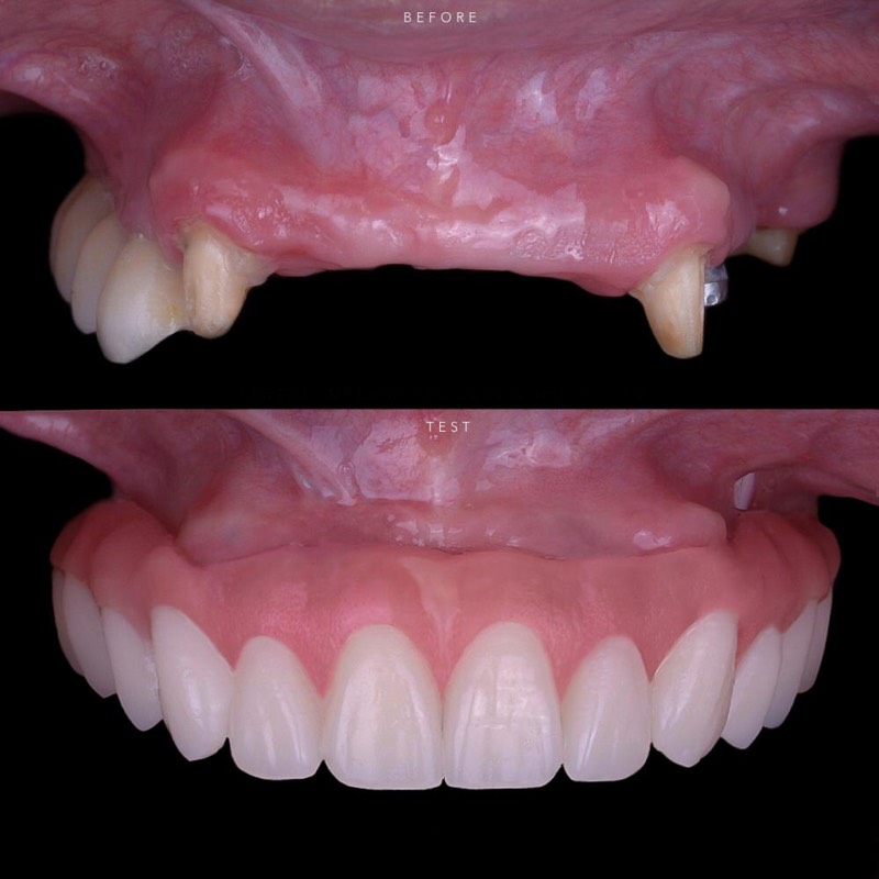 Reemplazo de pieza perdida con implante Straumann y corona de zirconia