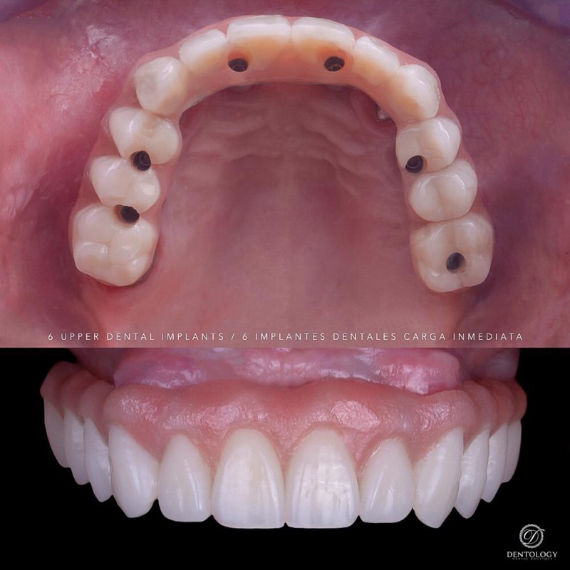 Before and after — Implant Crown — Seamless Match at DrDiente Mexico City