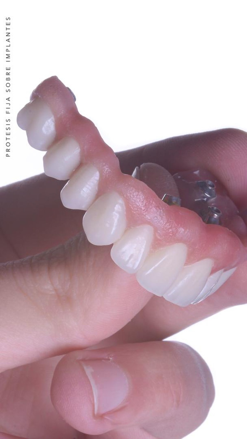 Before and after — Implant Rehabilitation — Porcelain Crowns at DrDiente Mexico City