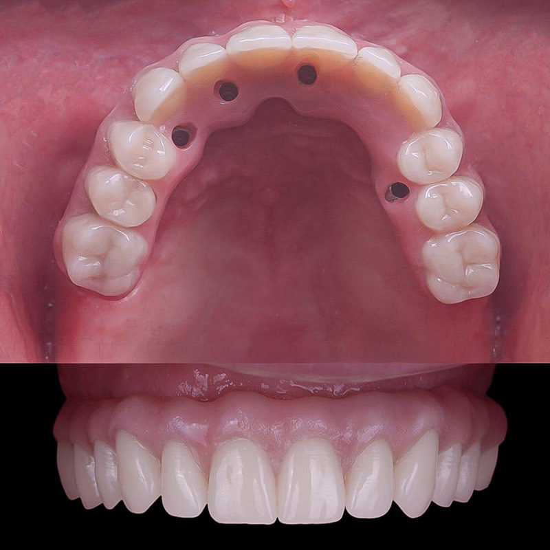Before and after — Molar Implant — Restored Function at DrDiente Mexico City