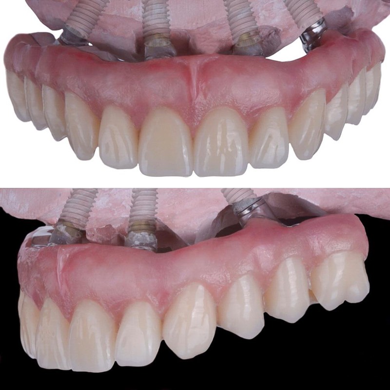 Before and after — Single Implant — Indistinguishable Result at DrDiente Mexico City