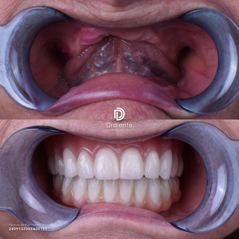 Rehabilitación completa con prótesis híbrida All-on-4 — dientes fijos en un día