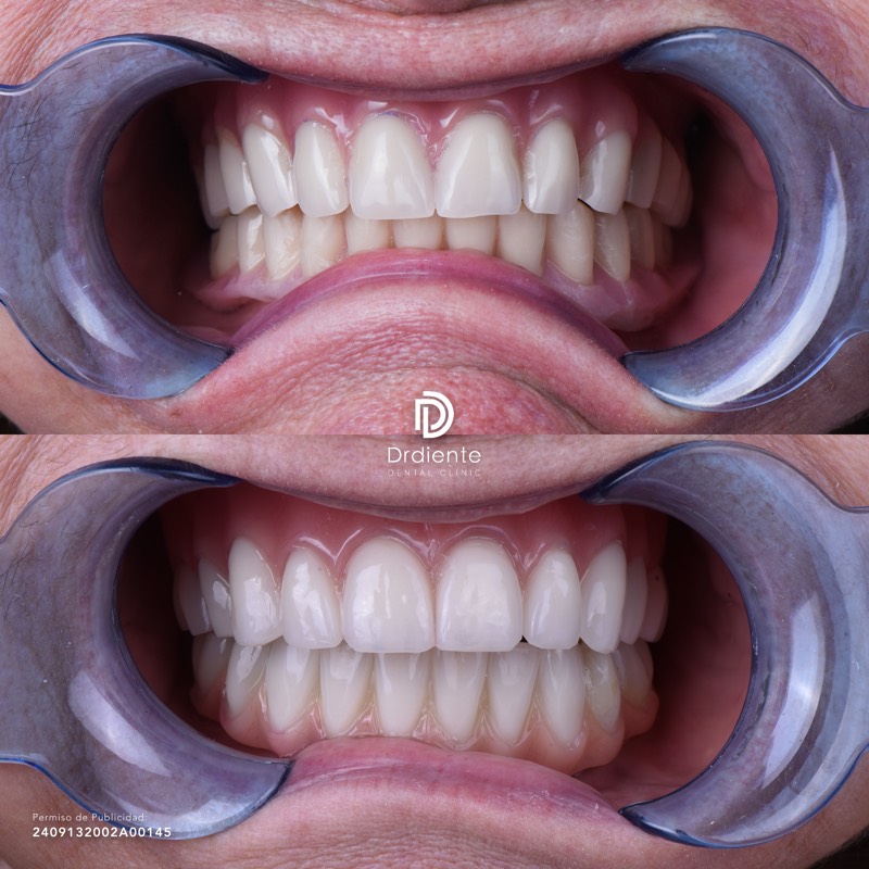 Transformación total — de dentadura removible a prótesis fija sobre implantes