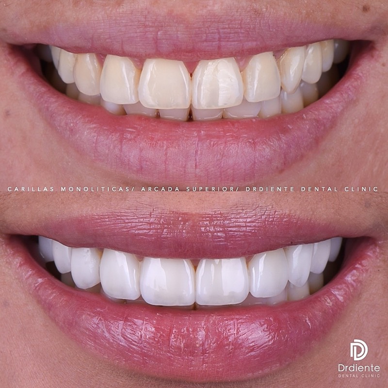 Before and after — Smile Design — Porcelain Veneers at DrDiente Mexico City