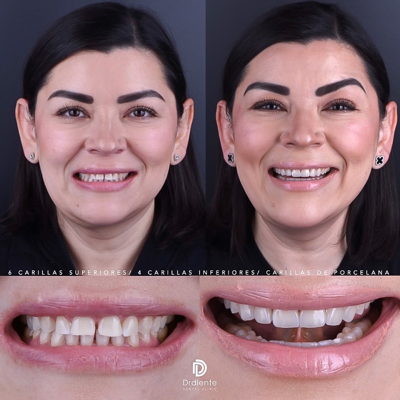 Before and after — Smile Design + Whitening at DrDiente Mexico City