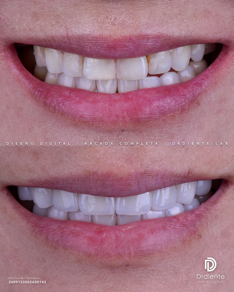 Before and after — Veneers — Color & Shape Correction at DrDiente Mexico City