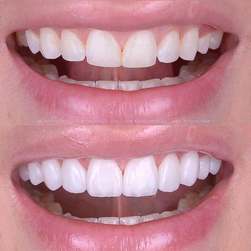 Before and after — Complete Smile Transformation at DrDiente Mexico City