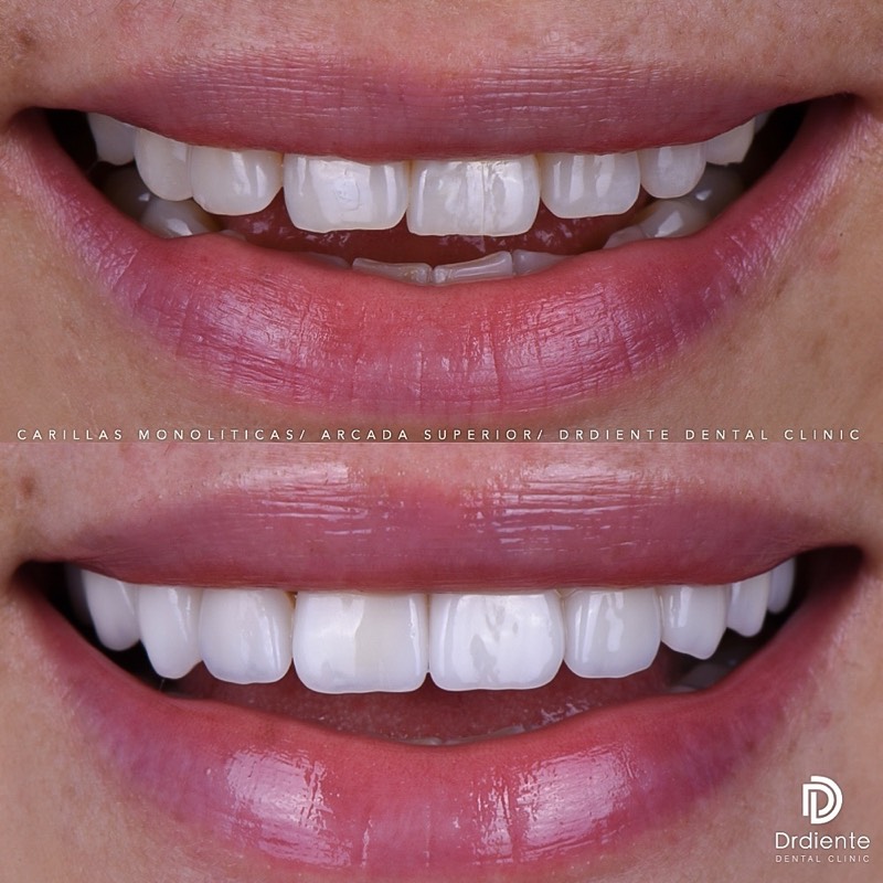 Before and after — Porcelain Veneers — Front Teeth Harmony at DrDiente Mexico City