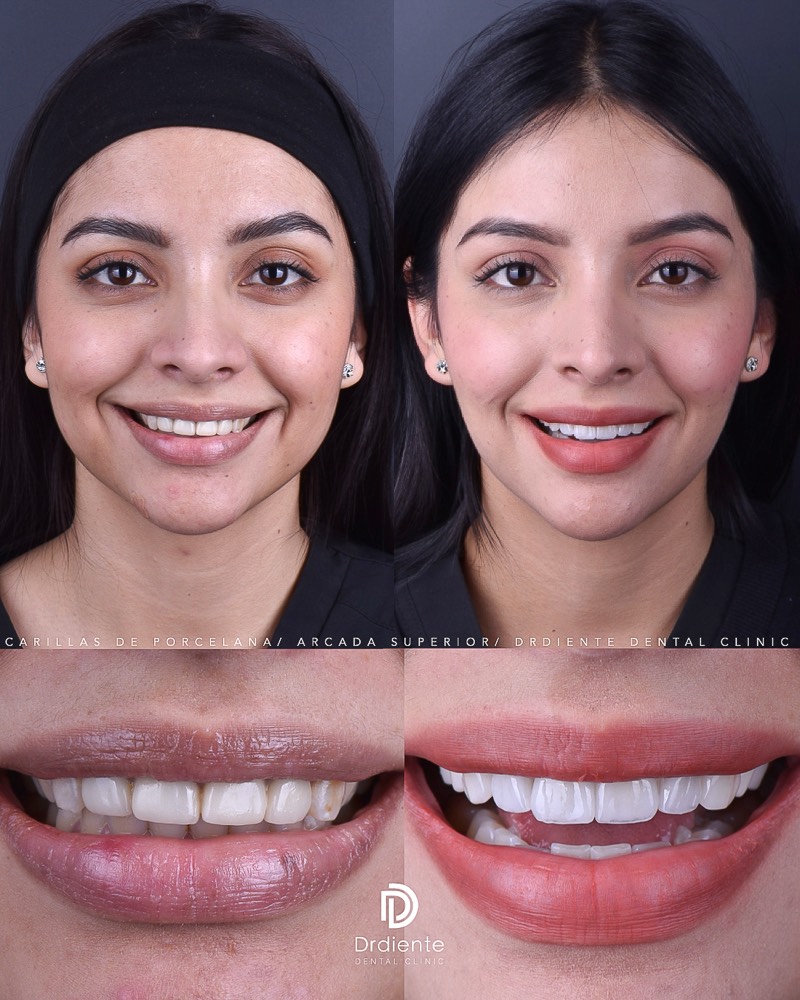 Diseño de Sonrisa — Carillas de Porcelana — Caso real antes y después
