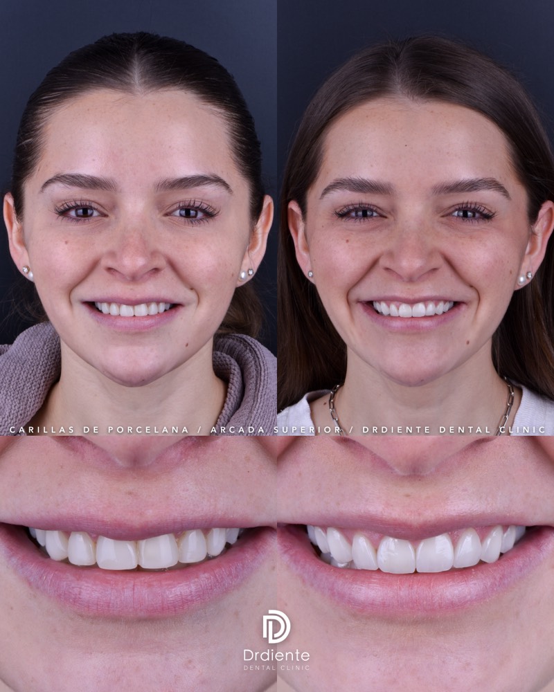 Sofía — buscaba una sonrisa luminosa y armónica. Carillas de disilicato de litio.