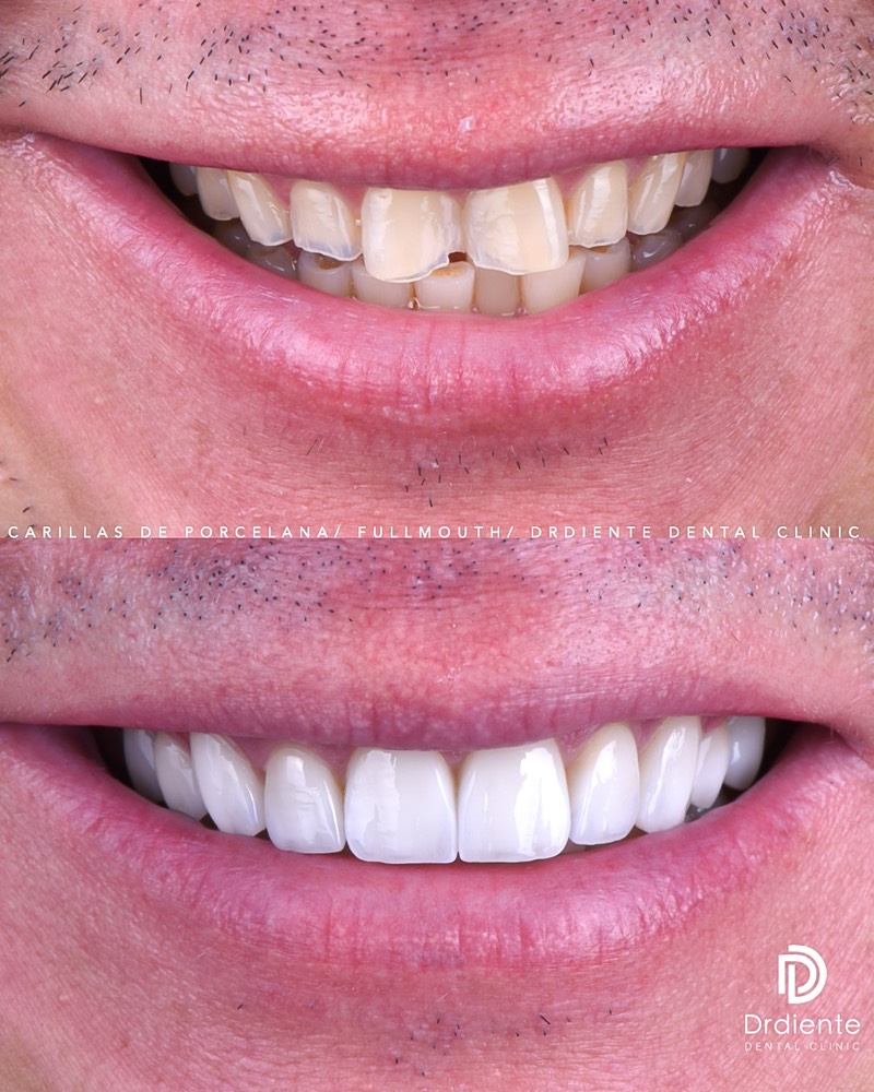 Before and after — Full Smile Makeover — E-max Veneers at DrDiente Mexico City