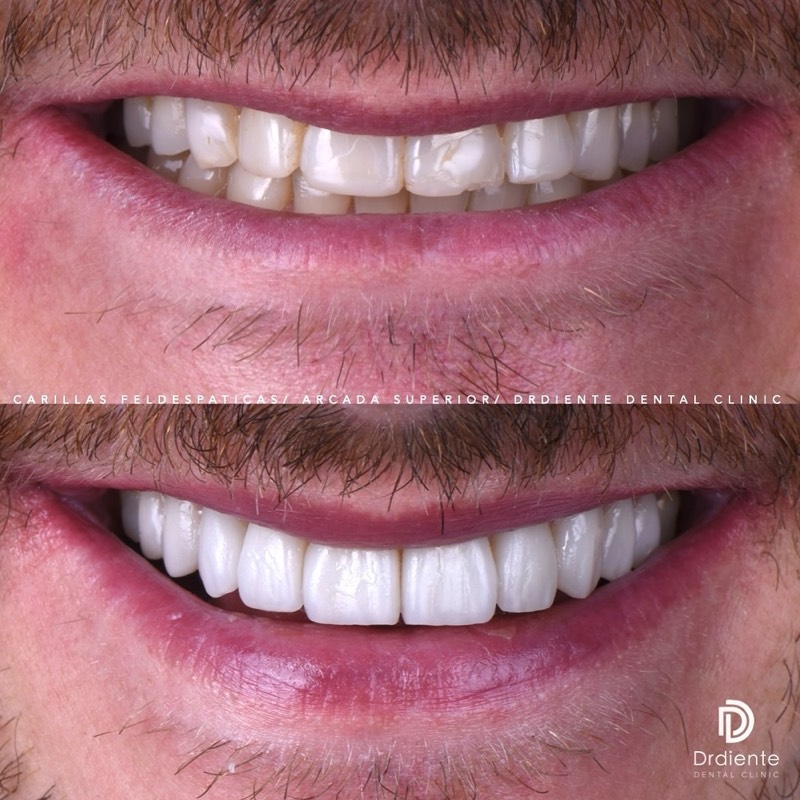 Before and after — Rejuvenated Smile — One-Trip Case at DrDiente Mexico City