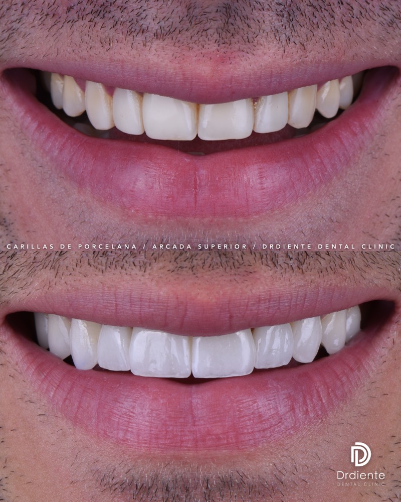 Before and after — Hollywood Smile — Full Arch at DrDiente Mexico City