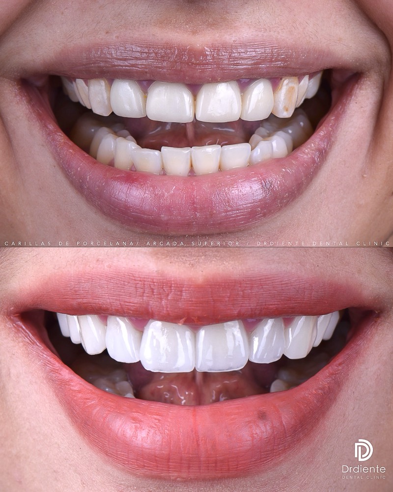 Before and after — Full Cosmetic Makeover at DrDiente Mexico City