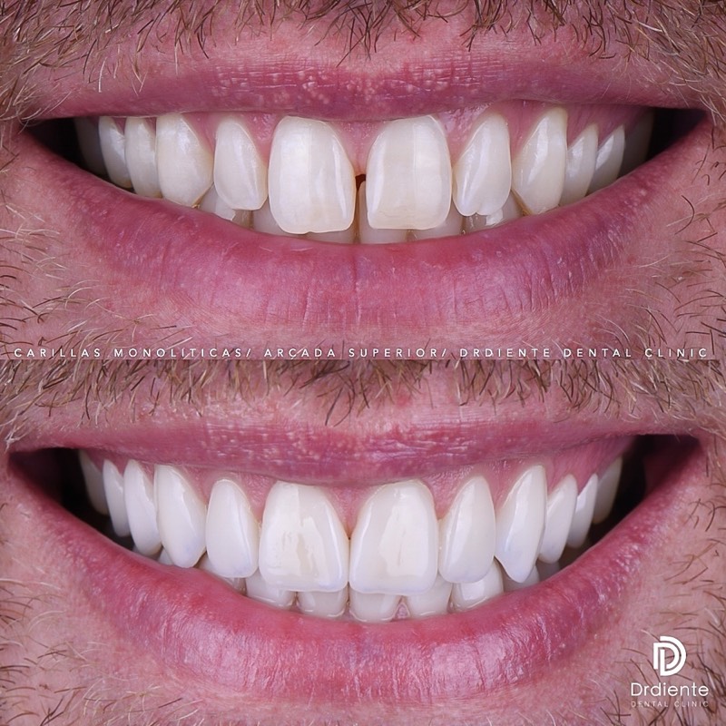 Antes y después de un diseño de sonrisa realizado en DrDiente